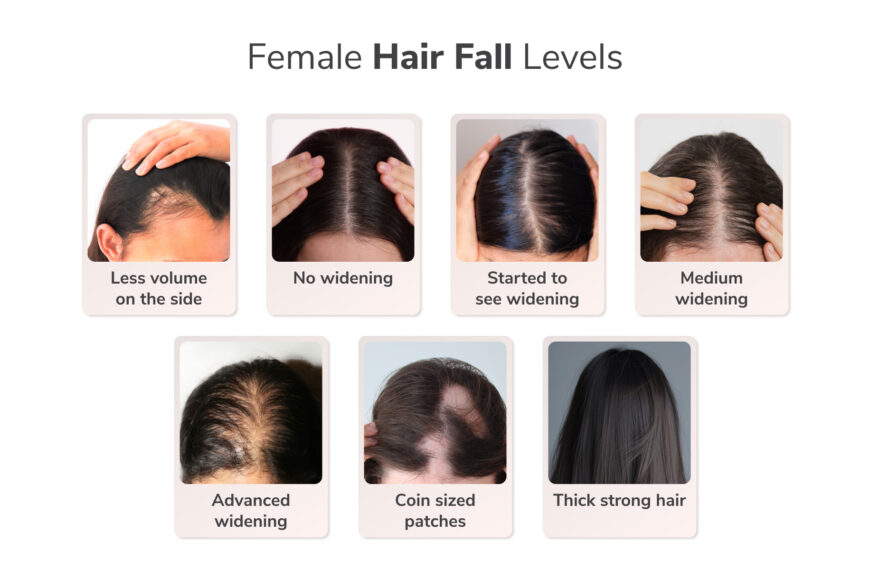 Traya study finds half of women aged 36-40 face advanced hair…